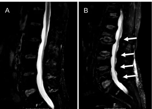 Figura 7 – Cortes sagitais da coluna lombar, obtidos por RM com ponderação em short tau inversion  recovery (STIR), realizadas ao 18º APD, com um intervalo de três meses (A→B)