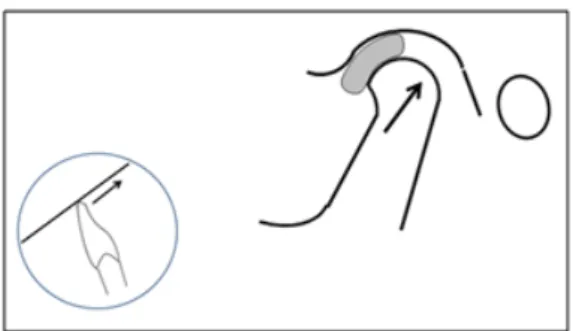 Figura 5 – Se o batente anterior for inclinado  para mesial a mandíbula tenderá para uma  posição anteriorizada (OKESON, 2008).