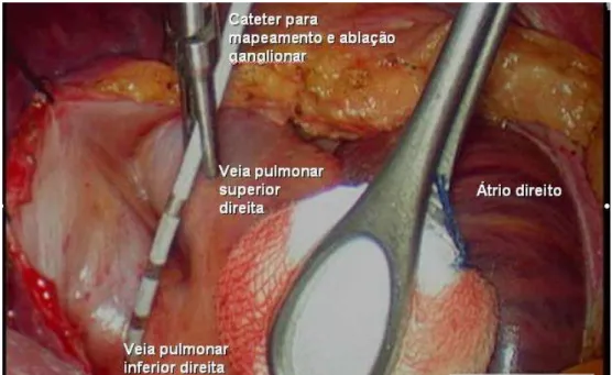 Figura 5: Exposição das veias pulmonares à direita, mapeamento e ablação  ganglionar. Adaptada de Wolf et.al, 2005 