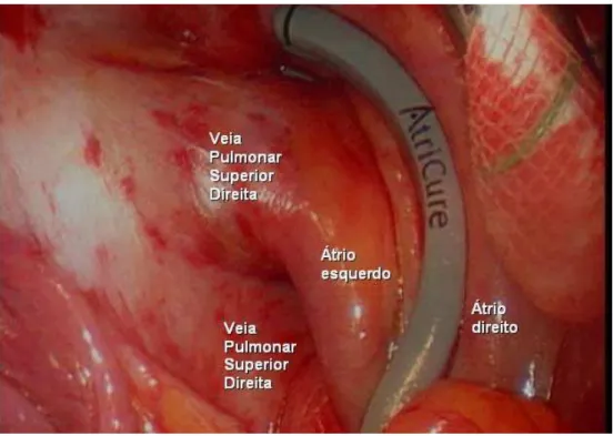 Figura 9: Pinça bipolar aplicada ao átrio esquerdo para o isolamento elétrico das  veias pulmonares e antro atrial