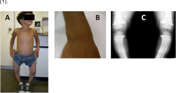Figura  3 – Manifestações clínicas e radiológicas do raquitismo. (A) Geno varo; (B)  Alargamento de punhos; (C) Encurvamento de fêmures e alterações metafisárias na  radiografia simples de membros inferiores