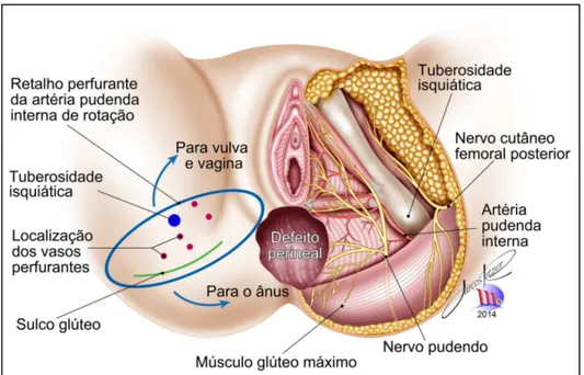 Figura 3 – Demarcação do retalho perfurante da artéria pudenda interna de  rotação 