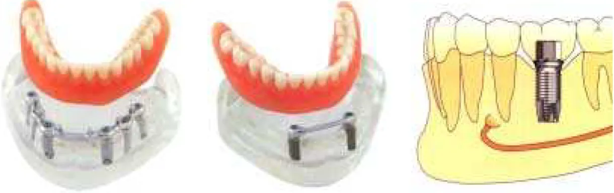 Fig. 4.2 – Algumas das aplicações clínicas para reabilitação de  pacientes com implantes de titânio aplicados à Odontologia (catálogo 