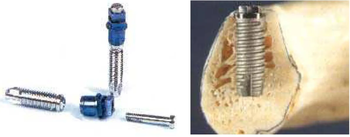 Fig. 5.1 – Implante dental  comercial de titânio master screw    