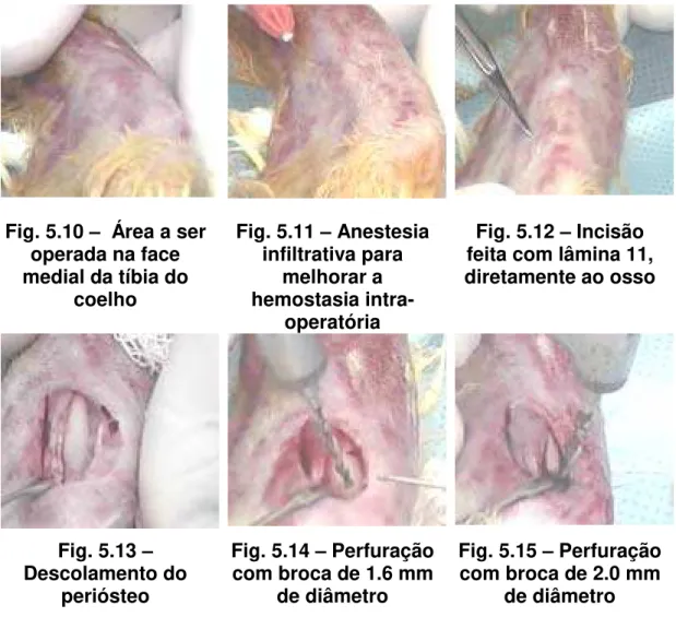 Fig. 5.9 – Seqüência padrão de perfuração óssea na realização de  implantes de titânio (Catálogo – Conexão Sistemas de Prótese – Brasil) 