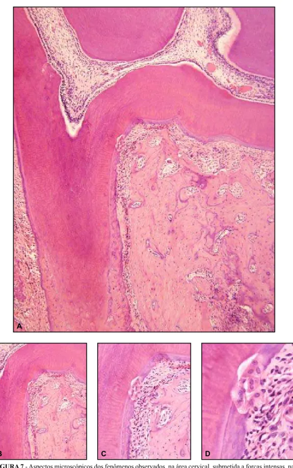 FiGurA 7 - aspectos microscópicos dos fenômenos observados, na área cervical, submetida a forças intensas, na  face mesial da raiz distal do primeiro molar murino, após 7 dias de movimentação dentária induzida