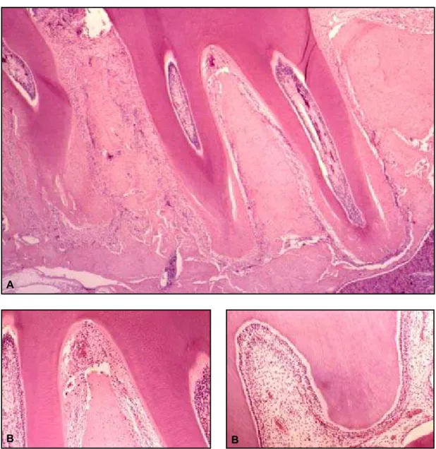 FiGurA 8 - aspectos microscópicos dos fenômenos observados, na área cervical, submetida a forças intensas, na  face mesial da raiz distal do primeiro molar murino, após 7 dias de movimentação dentária induzida