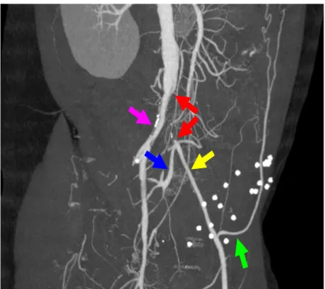 Figura 5. Representação tridimensional de imagem obtida por meio da  32x0,5-MDCTA, revelando oclusão da artéria ilíaca comum  esquerda (setas vermelhas) antes da sua bifurcação em artérias  ilíacas interna (seta azul) e externa (seta amarela)