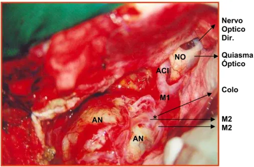 Figura 2 - Fotografia microcirúrgica de aneurisma gigante da  bifurcação da artéria cerebral média esquerda