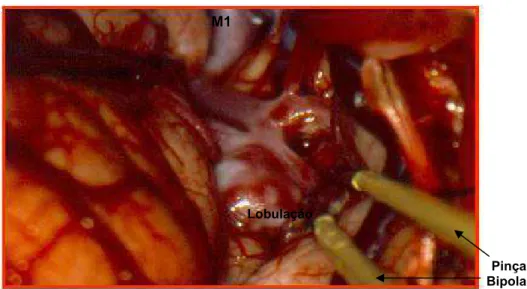 Figura 7 - Fotografia microcirúrgica demonstrando aneurisma complexo da  bifurcação da artéria cerebral média direita