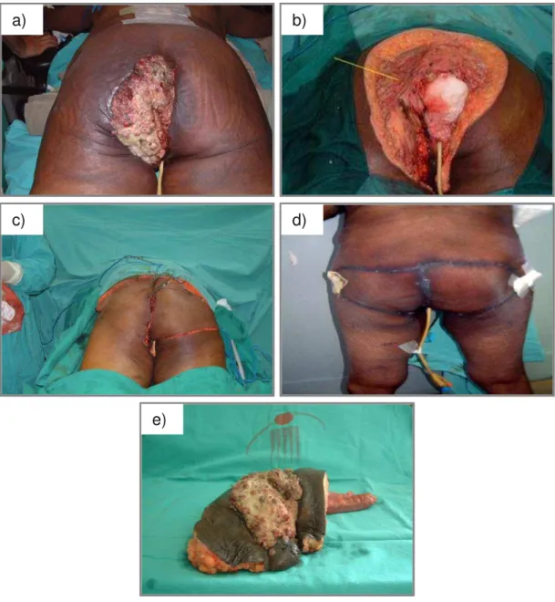 Figura 3 -  Paciente  portadora  de  CEDA,  submetida  a  RAP,  colpectomia,  vulvectomia e ressecção de musculatura glútea: a) paciente na posição  genupeitoral para a realização do tempo cirúrgico perineal; b) ressecção  finalizada, com exposição da pare