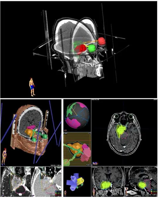 Figura 7 -   Representação  da  computação gráfica do planejamento da  RCEF para tratar com dose total de 50,4Gy fracionada com  180cGy/dia, de doente com meningeoma do seio cavernoso