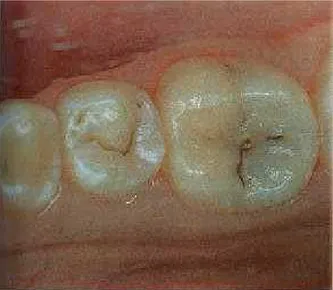 FIGURA 4.2  - Exame  Radiográfico (ilustrativo) de  primeiro molar inferior com radiolucidez  oclusal compatível com cárie dentinária  