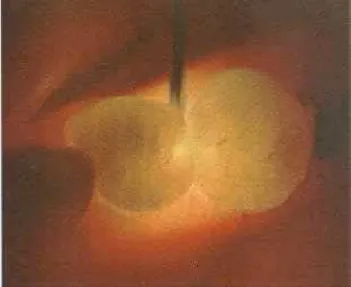 FIGURA 4.9 - Exame  FOTI  da  distal  do segundo pré- pré-molar inferior mostrando sombra escura sugestiva de  cárie dentinária pelo bloqueio da transmissão da luz 
