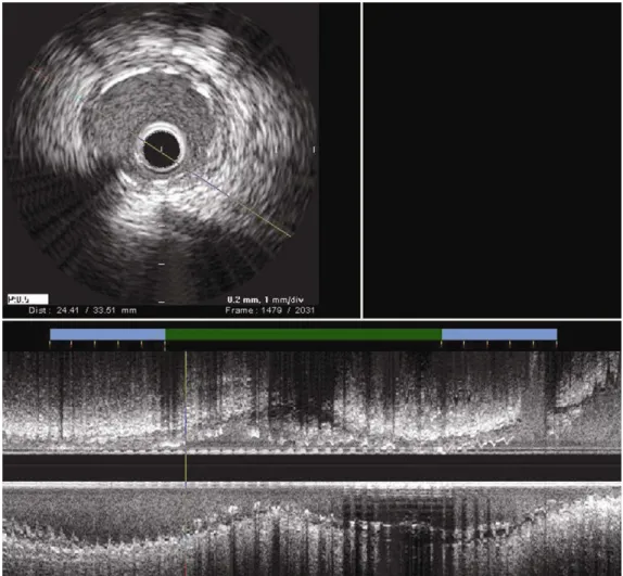 FIGURA 2.   Imagem  obtida  com  o  programa  echoPlaque ®   3.0  demonstrando em verde o segmento tratado com stent e em  azul  as  bordas  proximais e  distais  (5  mm  de  cada  lado,  a  partir  do  stent)