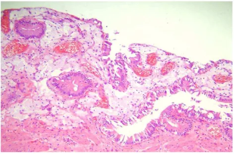 Figura  4.   Foto de microscopia óptica da vesícula biliar com  colesterolose 