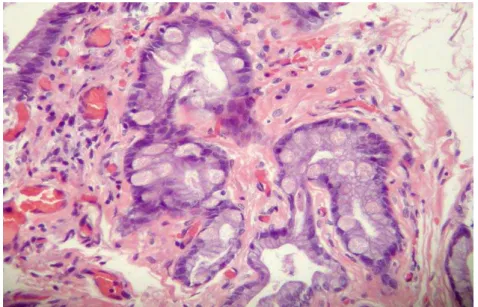Figura  6.   Foto de microscopia óptica da vesícula biliar com  metaplasia intestinal 