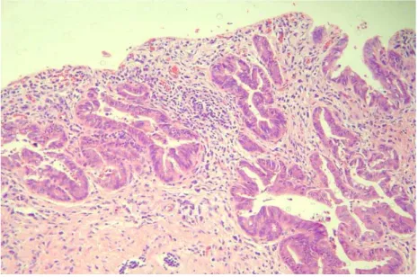 Figura  7.   Foto de microscopia óptica da vesícula biliar com  adenocarcinoma, apresentando área de displasia 