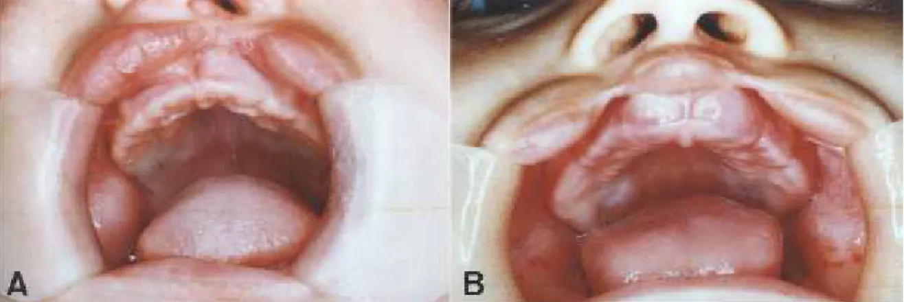 FIGURA 1 - Fissura de lábio incompleta (A - unilateral e  B - bilateral) e Fissura de lábio e alvéolo completa (C - unilateral e D - bilateral)