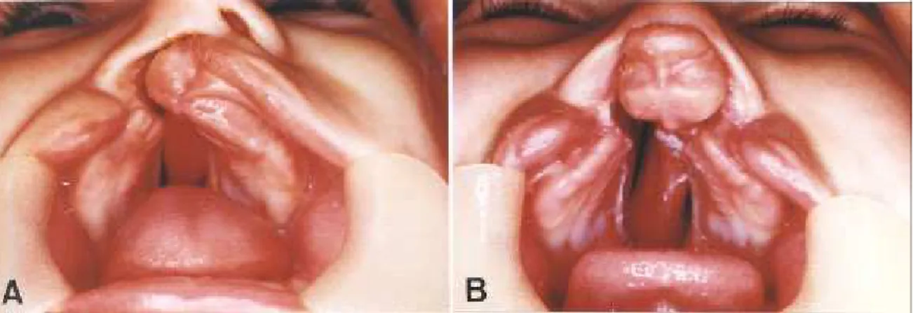 FIGURA  3 -  Fissura completa de lábio e palato (A  - unilateral e  B  - -bilateral).
