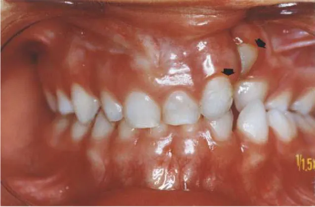 FIGURA 7 –  Local da colheita da amostra nos dentes adjacentes à fissura (grupo experimental).