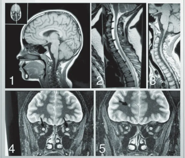 Figura 2. Imagem 1  - RM de crânio (corte sagital) sem alterações, em 1996, no primeiro surto