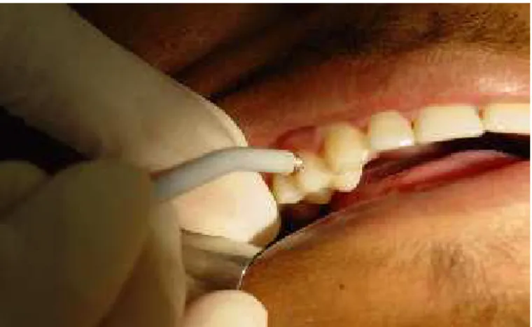Figura 4.3 - Aplicação do estímulo elétrico no elemento dentário testado