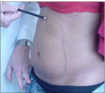 Figura 2 -  Demarcação  do  perímetro  do  acúmulo  de  gordura  na  parede  anterior  do  abdome 
