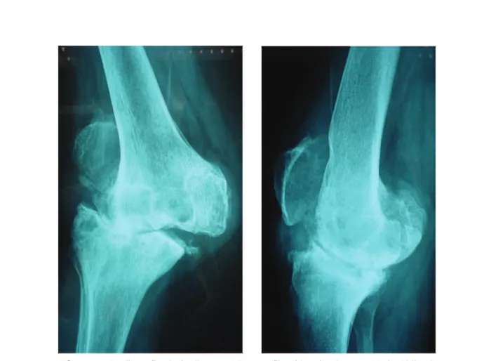Figura 1 . Radiografia do joelho em AP e perfil evidenciando grau V de Ahlbäck