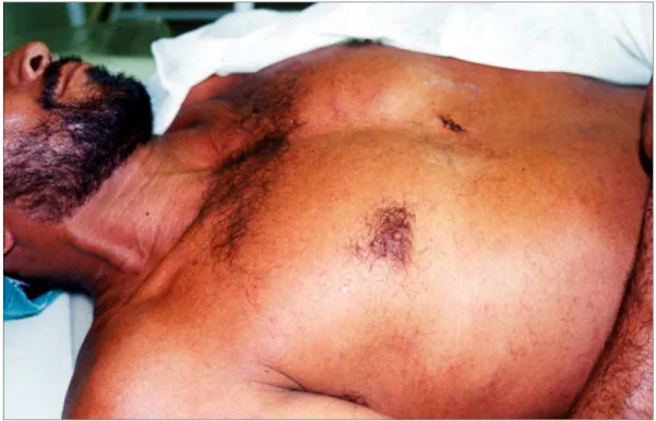 Figura  4  -  Paciente vítima de ferimento por arma branca na área de Ziedler  apresentando turgência jugular ao exame físico [Fonte: Arquivo do autor] 