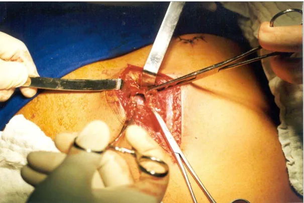 Figura 8 -  Janela pericárdica subxifóidea realizada em doente com suspeita de lesão  cardíaca [Fonte: Arquivo do autor] 