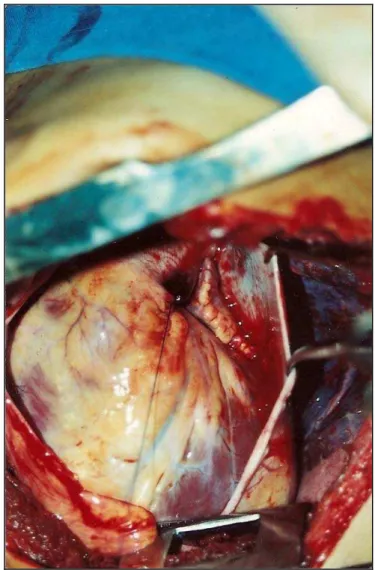 Figura 9 -  Aspecto intra-operatório de lesão de ventrículo direito (VD) por arma  branca acessada por toracotomia ântero-lateral esquerda [Fonte: Arquivo  do autor] 