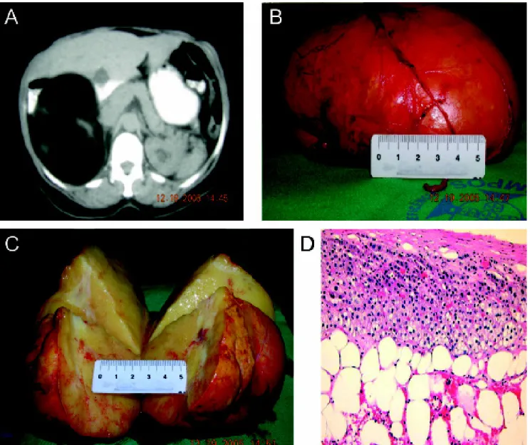 Figura 1. A: Corte tomográfico evidenciando tumoração em supra-renal direita; B, C: Peça cirúrgica; D: Padrão histológico com riqueza em tecido adiposo e hemopoético.