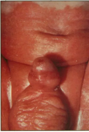 Figura 2.1. Ilustração dermatite das fraldas. 73    