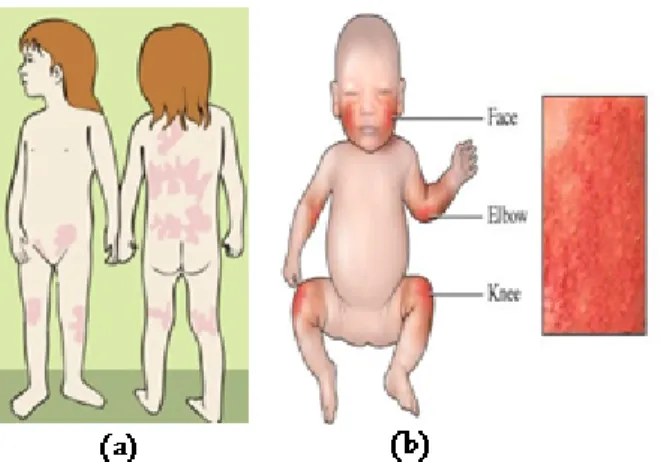 Figura 2.2. Zonas de aparecimento de eczema em crianças (a) e bebés (b) (adaptado de 87,88 )