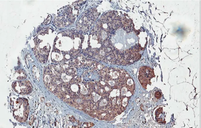 Figura 4 – Fotomicrografia de carcinoma ductal mamário com forte imunoexpressão  citoplasmática de topoisomerase IIIβ (aumento de 400x)