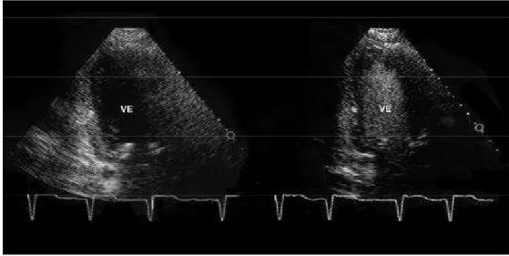 Figura 7. Imagem ecocardiográfica no plano apical duas câmaras em imagem fundamental antes (esquerda), e após (direita) a administração do contrate, em que se observou uma melhora significativa do delineamento endocárdico na parede anterior.