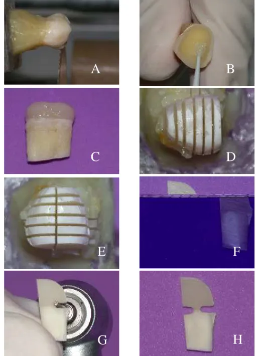 FIGURA 1  – A) Corte perpendicular ao longo eixo do dente; B) Aplicação do sistema  adesivo; C) Coroa reconstruída; D,E) Vista oclusal do dente após os seccionamentos seriados; 