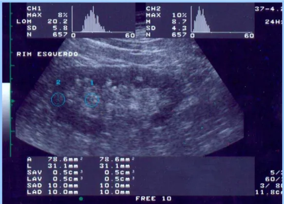 Figura 1. Medida da ecogenicidade renal – a relação parênquimo sinusal através  da ultrassonografia renal (histograma) 