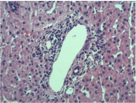 Figura 1-  Caso nº 3 – Hepatite crônica com alteração estrutural grau 1: 