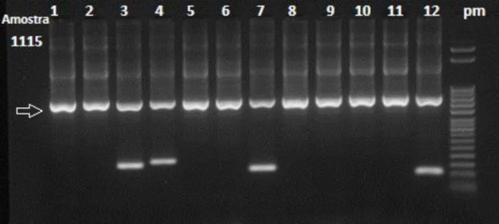Figura  7  –  Resultado  da  análise  de  DNA  genômico  humano  quanto  à  presença  ou  ausência de alelos HLA-DQ e HLA-DR predisponentes à DC e quanto à homozigose do  alelo  DQB1*02