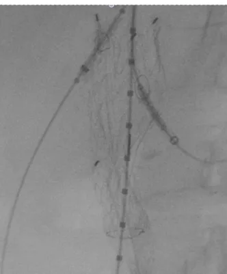Foto 6:  Imagem da fenestra vista pela radioscopia, marcada com os  pedaços de fios-guia na borda da fenestra