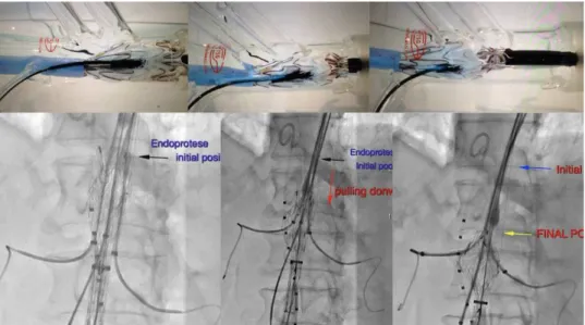 Foto  11.  Movimentação  da  EPm  até  a  posição  desejada,  mesmo  após  o  cateterismo  das  artérias viscerais é possível movimentar a EPm