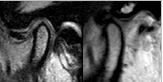 Figura 4.9 - Deslocamento anterior do disco articular sem redução (DDAsR) – maior dificuldade para  observar cartilagem