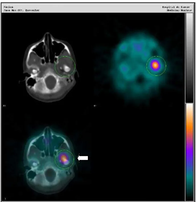 Figura 4.7 - Imagens de fusão co-registradas SPECT/CT com  99m Tc-MDP no plano transaxial, do mesmo paciente, demonstrando hiperconcentração focal do radiofármaco na projeção da ATM esquerda (SPECT/CT + ATM esquerda)