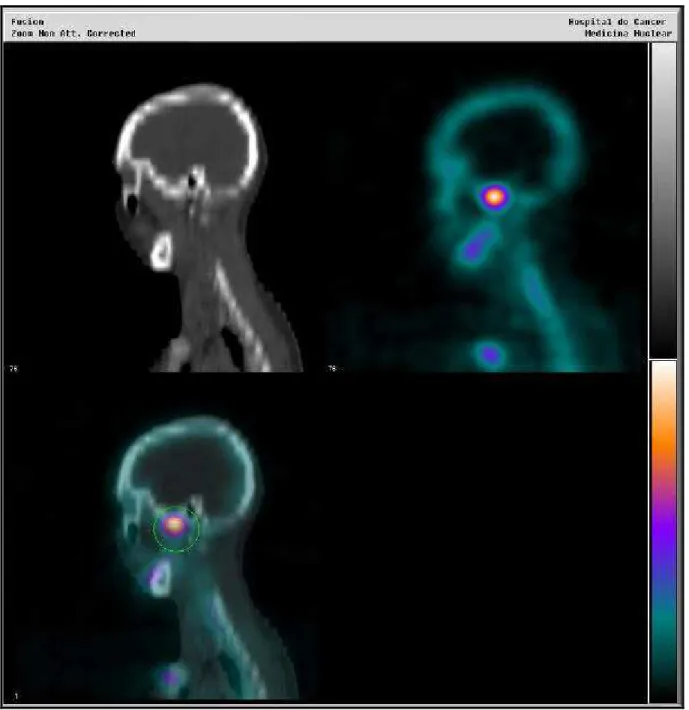 Figura 4.8 - Imagens de fusão co-registradas SPECT/CT com  99m Tc-MDP no plano sagital, do mesmo paciente, demonstrando hiperconcentração focal intensa do radiofármaco na projeção da ATM esquerda (SPECT/CT  + ATM esquerda) e discreta no corpo da mandíbula 