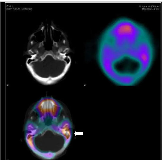Figura 4.9 - Imagens de fusão co-registradas SPECT/CT com  99m Tc-MDP no plano transaxial, de outro paciente, demonstrando hiperconcentração focal intensa do radiofármaco na projeção do ouvido interno e mastóide do lado esquerdo (SPECT/CT + extra-ATM)