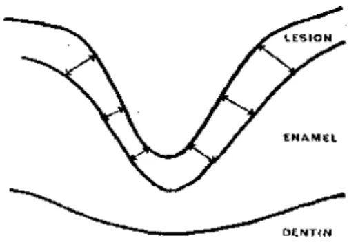 Figura 2 –  Diagrama descrevendo a técnica de mensuração. As setas mostram os  pontos nos quais foram realizadas as medidas de profundidade na área  da lesão ( lesion = lesão; enamel = esmalte; dentin = dentina 