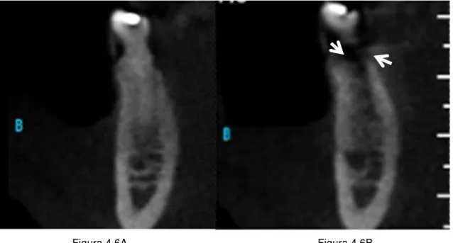Figura  4.6A  e  4.6B-  Imagem  representativa  da  influência  severa  do  artefato.  Imagem  obtida  pré- pré-colocação  (Figura  4.6A)  e  pós-pré-colocação  (Figura  6B)  do  implante