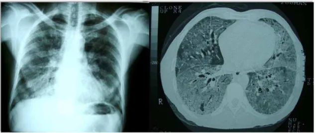 Figura 7 - Radiografia e tomografia de tórax de paciente com leptospirose grave e  hemorragia pulmonar